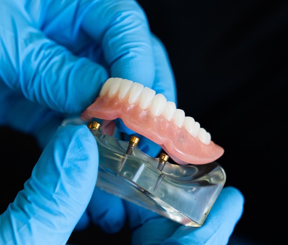 A dental professional holding a model of an implant-retained lower denture, showing the implant posts it clips onto